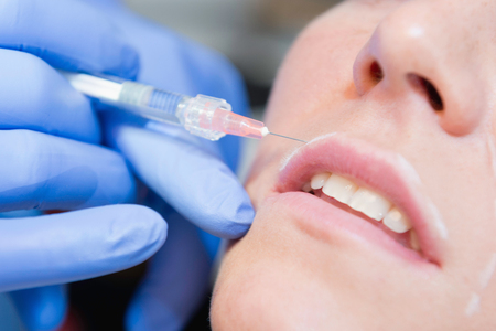 Beauty treatment with hyaluronic acid on upper lip, selective focusの写真素材