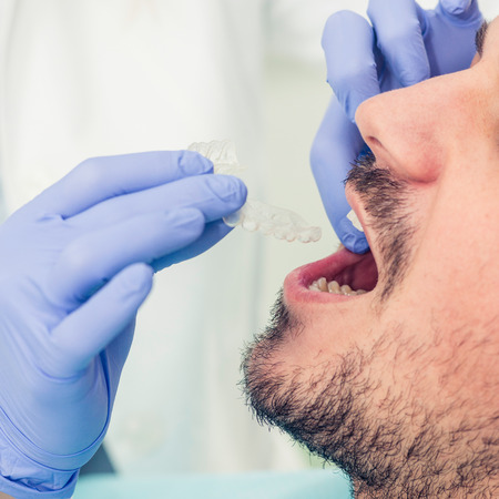 Dentist putting putting invisible braces to patient's mouthの写真素材
