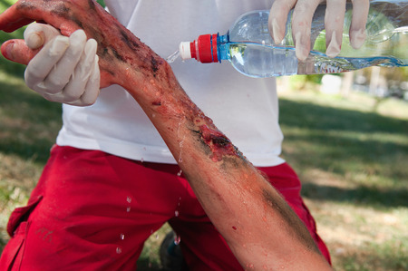 Paramedic cooling third degree hand burns with water. Simulated exercise, professional medical make-up, not a real injury.の写真素材