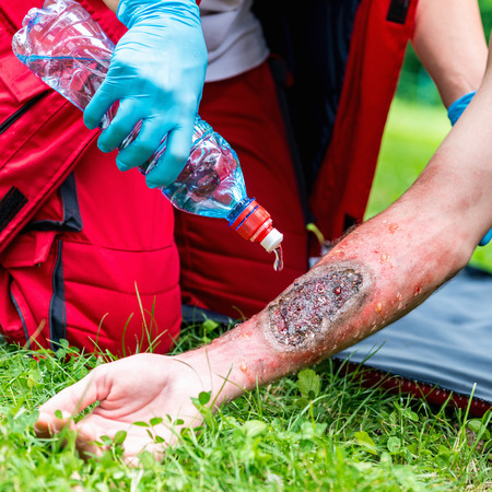 Medical worker treating burns on male's hand. First aid treatment outdoors. First aid practiceの写真素材