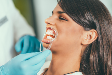Teeth Whitening Procedureの写真素材