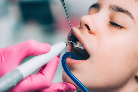 Orthodontist cleaning girlâs teeth with dental bracesの写真素材