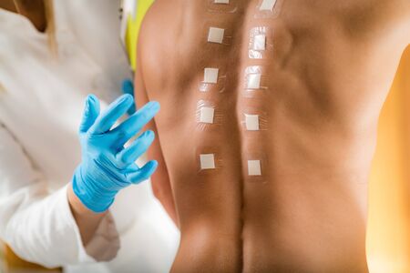 Immunologist Doing Skin Prick Allergy Test on a Womanâs Backの写真素材