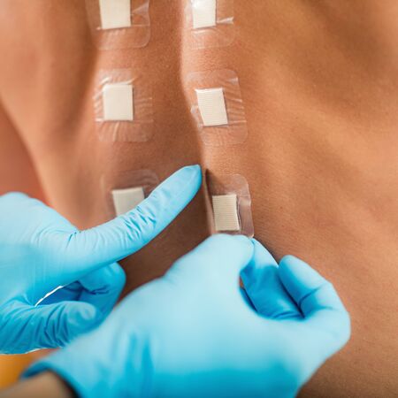 Immunologist Doing Skin Prick Allergy Test on a Womanâ€™s Back