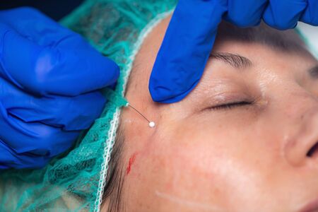 Woman Having Mesotherapy Treatment in Aesthetic Medicine Clinic