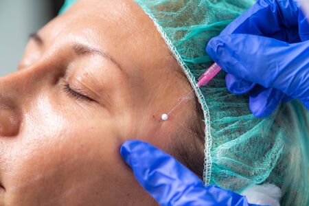 3D Meso Threads for Face Lifting and Contouring. Aesthetic Medicine Concept.