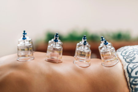 Hijama cupping treatment on women's backの写真素材