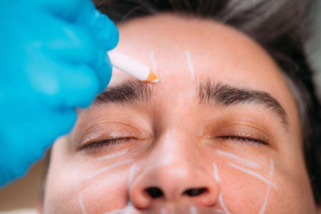 Dermal Fillers for Men. Cosmetologist with surgical gloves marking middle-aged manâs face for dermal filler treatment.の写真素材