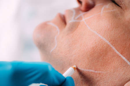 Anti-aging dermal filler treatment for men. Doctor with surgical gloves marking middle-aged manâs face for dermal filler treatment.の写真素材