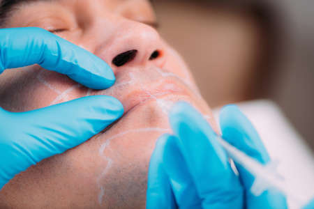 Doctor Injecting Dermal Filler into Manâs Lipsの写真素材