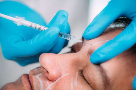 Dermal Filler injection. Middle-aged man receives dermal filler injection for reduction of forehead wrinklesâanti-aging concept.の写真素材