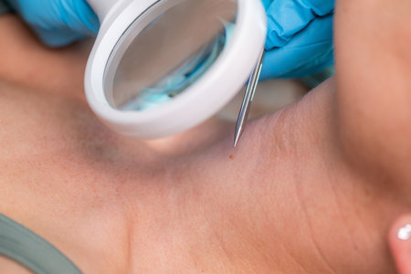 Dermatologist uses radio waves to remove warts from womanâ€™s neck for smooth and blemish-free...