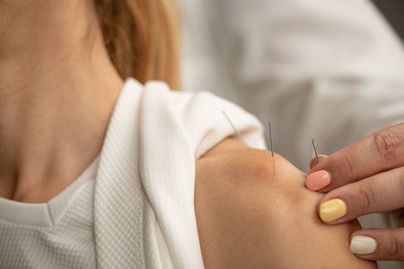 Acupuncture Treatment for Shoulder Pain and Rotator Cuff Injuriesの写真素材