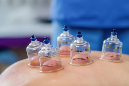 Cupping therapy on the back is conducted in a physical therapy session for a woman in a clinical environment. Silicone suction cups are applied to the skin, improving blood circulation and easing muscle tension, with subtle redness highlighting the therapyâs role in pain managementの写真素材