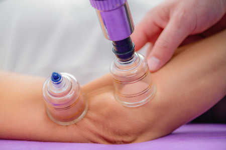 Cupping therapy on the elbow is applied during a physical therapy session for a woman in a clinical...