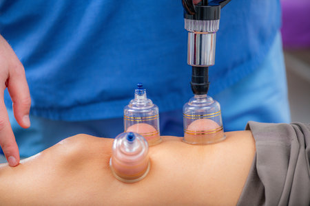 Cupping therapy on the knee targets pain reduction in a physical therapy session for a woman. Clear silicone suction cups are placed on the skin, enhancing blood flow and easing muscle stiffness, with visible skin elevation under the cups, supporting better mobility and recovery.の写真素材