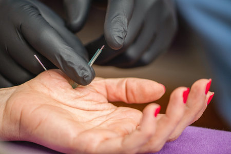 Woman receiving dry needling therapy on her thumb and hand during a physical therapy session. The...