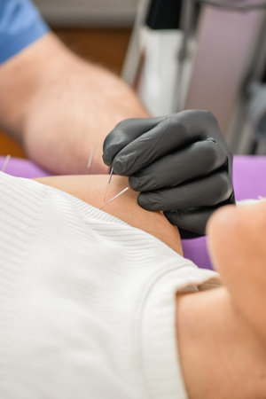 Woman receiving dry needling therapy on her shoulder during a physical therapy session. The...