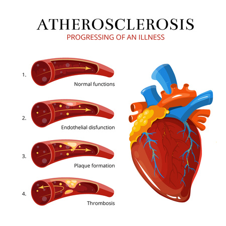 Atherosclerosis, blood clot formation. Vector medical illustration. Internal organ, thrombosis and endothelialのイラスト素材