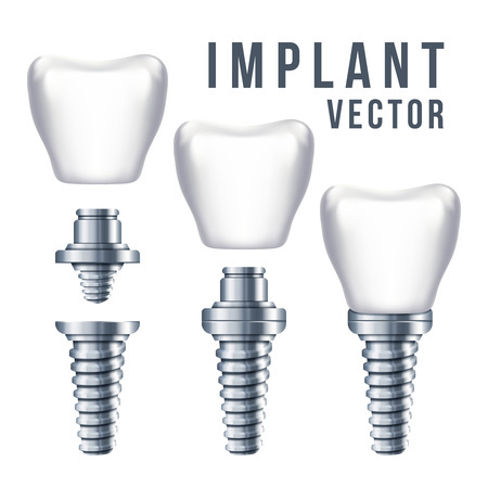 Dental tooth implant and parts vector illustration. Implantation dentistry and care to teethのイラスト素材