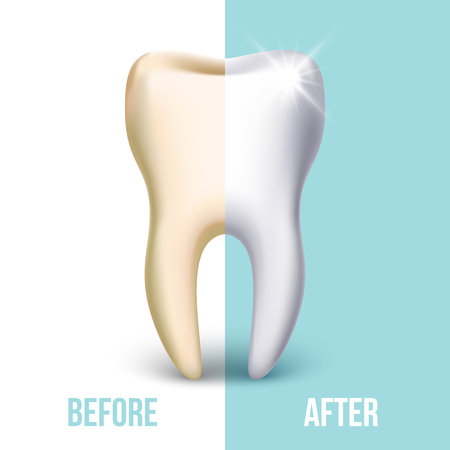 Dental veneer, teeth whitening vector concept. Stomatology and healthcare, white tooth illustrationのイラスト素材