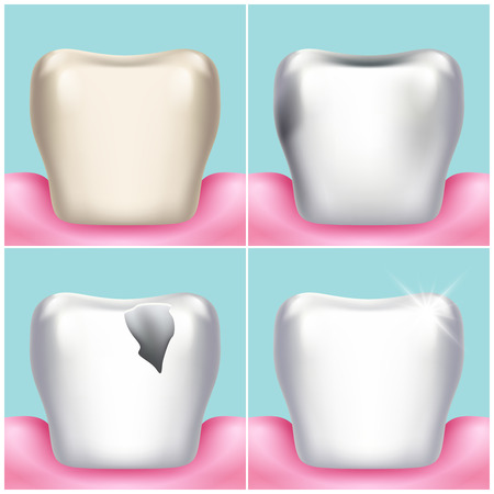 Dental problems, caries, plaque and gum disease, healthy tooth vector illustration. Stomatology and treat unhealthy teeth illustrationのイラスト素材