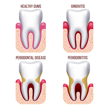 Human gum disease, gums bleeding. tooth disease prevention dental, oral care vector infographics. Gingivitis and periodontal, periodontitis illustrationのイラスト素材
