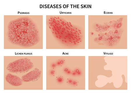 Skin diseases. Derma infection, eczema and psoriasis. Dermatology vector illustrationのイラスト素材
