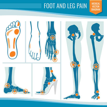 Foot and leg pain. Arthritis and rheumatism orthopedic medical vector diagram. Illustration of rheumatism leg jointのイラスト素材