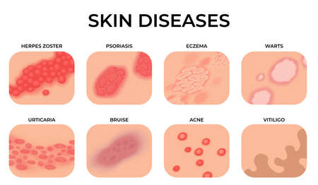 Skin disease. Different diseases, epidermis surface with eczema. Dermatology, allergy symptoms. Human body psoriasis, medical recent vector set. Illustration of skin disease problemのイラスト素材