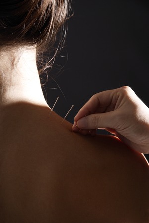 therapist applying acupuncture needles to woman's neck