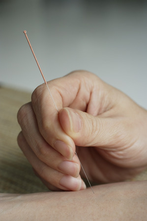 acupuncture needle being insertedの写真素材