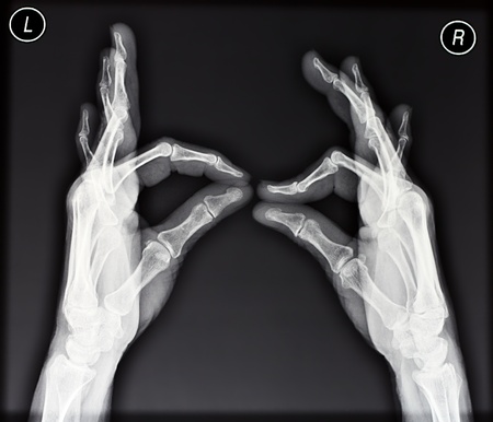 Plain X-ray of two hands showing ok signの写真素材