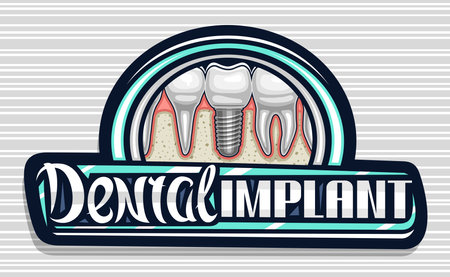 Vector logo for Dental Implant Clinic, dark decorative sign board with illustration of porcelain molar with screw, unique calligraphy lettering for words dental implant for professional denture clinicのイラスト素材