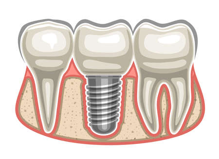 Vector illustration of Dental Implant, 3 human teeth in a row and ceramic artificial tooth with...
