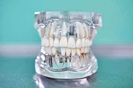 Transparent Model of a human jaw. Oral dental hygiene concept. Dental dentistry students teaching model showing teeth, roots, gums, gum disease, caries and plaque.の写真素材