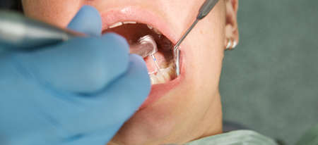 Close up Portrait Of Female Patient Having Terrible Toothache. Dentist Curing Teeth Cavity In Blue...
