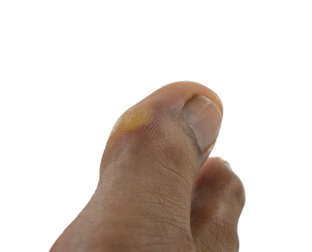 The position of the callus on side of toeの写真素材