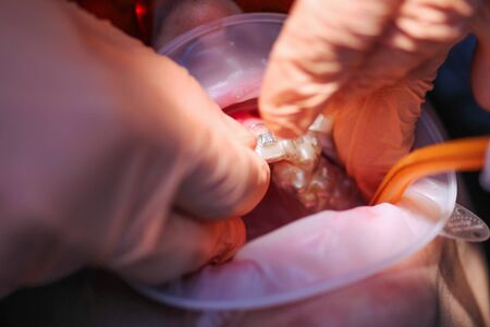 The doctor inserts the patient braces on the teeth. The process of the work of an orthodontistの写真素材