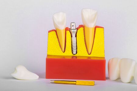 Dental Implant Model. Modern stomatology concept. Selective focus. Space for text. Tooth implant in the model human teethの写真素材