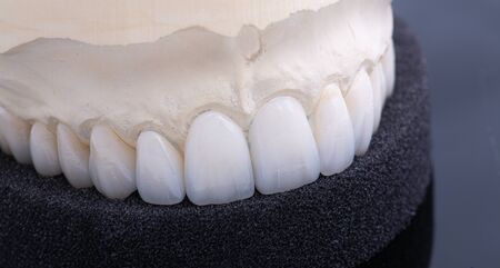 Dental crowns. Close-up ceramic tooth crown on a plaster model. The work of a dental technician.の写真素材