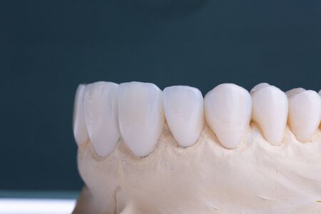 Implan model tooth with implan and crown.の写真素材