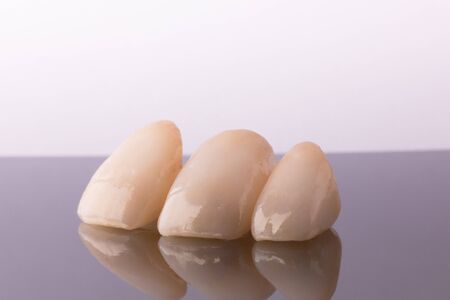Ceramic veneers. Dentistry teeth conceptの写真素材