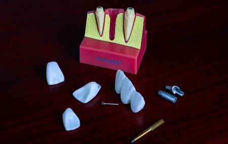 Ceramic veneers on mirror background. Dentistry teeth concept