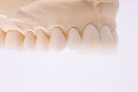 Dental crowns. Close-up ceramic tooth crown on a plaster model. The work of a dental technician. の写真素材