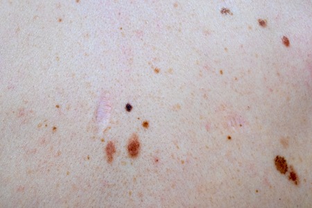 A melanocytic nevus also known as nevocytic , nevus-cell and commonly as a mole is a type of tumor that contains nevus cells.