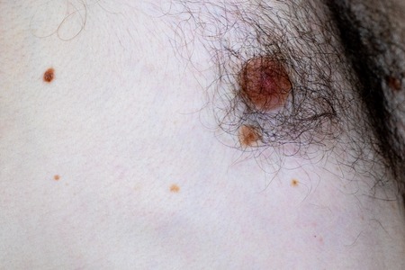 A melanocytic nevus also known as nevocytic , nevus-cell and commonly as a mole is a type of tumor that contains nevus cells.の写真素材