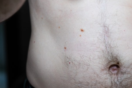 Melanocytic nevus, some of them dyplastic or atypical, on a caucasian man of 36 years oldの写真素材