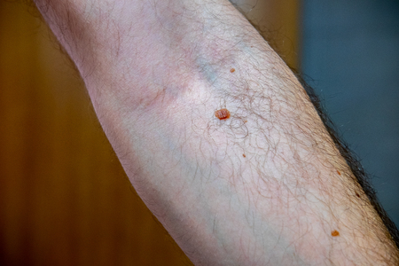 Melanocytic nevus, some of them dyplastic or atypical, on a caucasian man of 36 years old