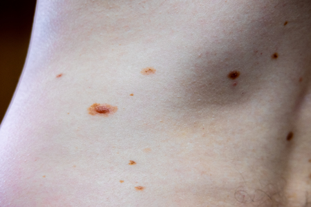 A melanocytic nevus also known as nevocytic , nevus-cell and commonly as a mole is a type of tumor that contains nevus cells.の写真素材